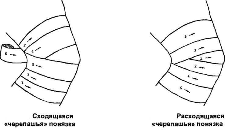 Наложение тугой повязки на колено Наложение тугой повязки на колено