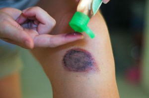 Нанесение на место ушиба