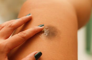 Нанесение мази на область ушиба