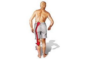 Направление боли при люмбоишиалгии поясницы Направление боли при люмбоишиалгии поясницы