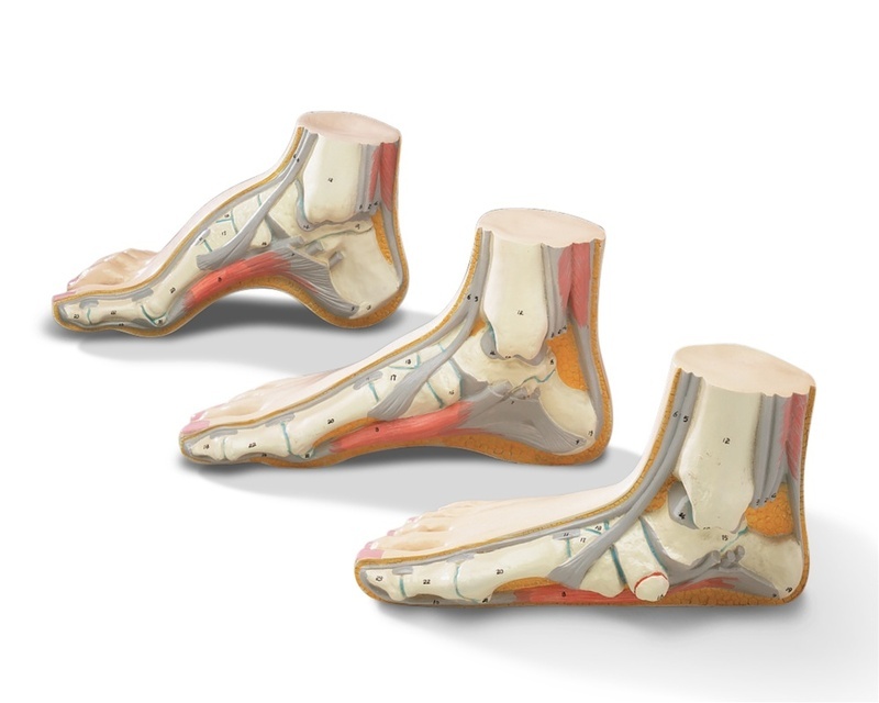 Напряжение связок стопы при плоскостопии Напряжение связок стопы при плоскостопии