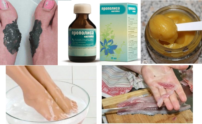 Народное лечение косточки на ноге Народное лечение косточки на ноге