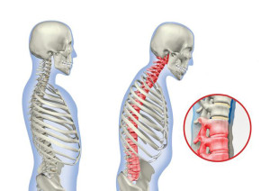 Нарушение осанки Нарушение осанки