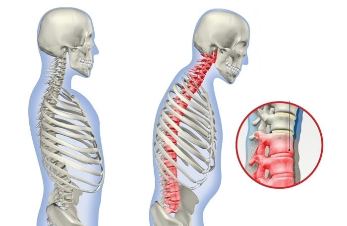 Нарушение осанки вследствие спондилоартрита Нарушение осанки вследствие спондилоартрита