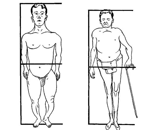 Нарушение скелета при хондродистрофии Нарушение скелета при хондродистрофии
