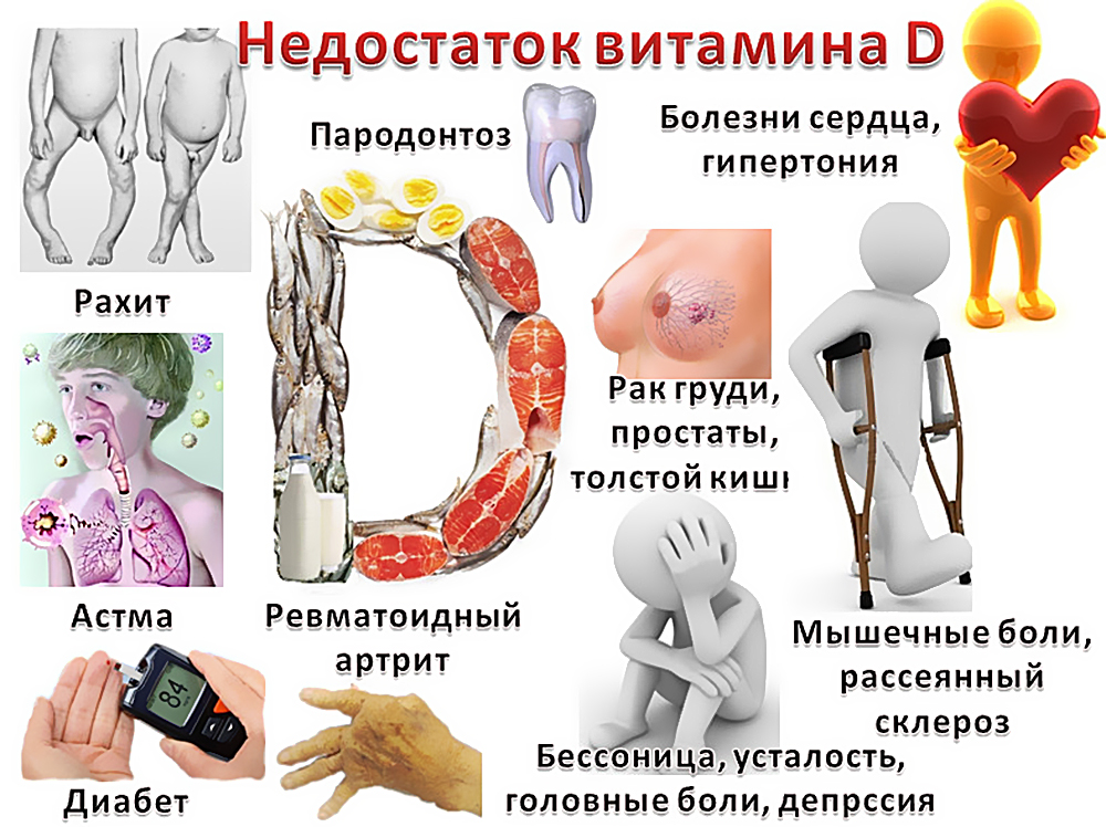 Болезни при недостатке витамина Д Болезни при недостатке витамина Д