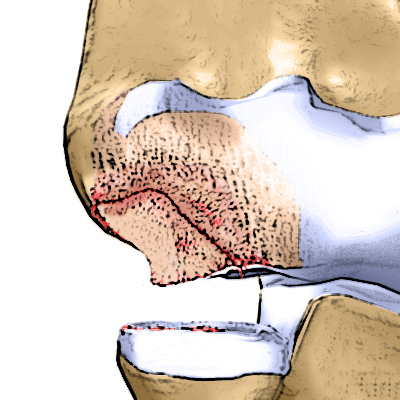 Некроз хрящевой ткани Некроз хрящевой ткани