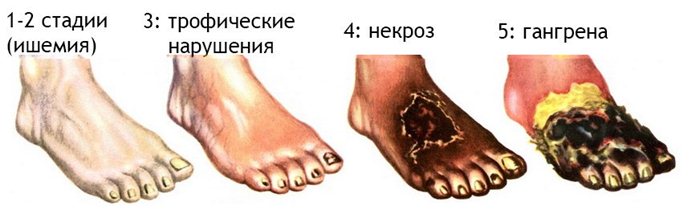 Развитие гангрены на фоне некроза Развитие гангрены на фоне некроза
