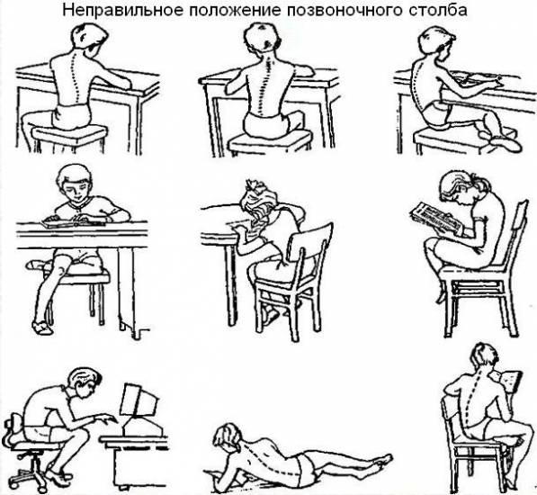 Сколиоз позвоночника