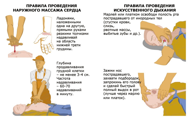 Непрямой массаж сердца и искусственное дыхание Непрямой массаж сердца и искусственное дыхание