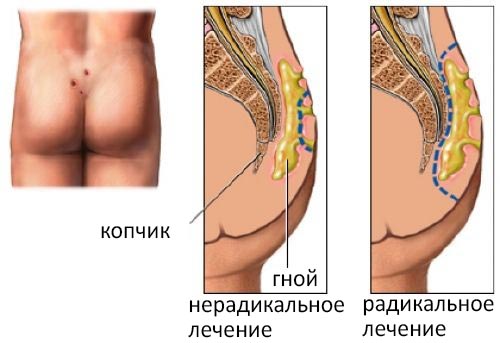 Нерадикальное и радикальное иссечение кисты Нерадикальное и радикальное иссечение кисты