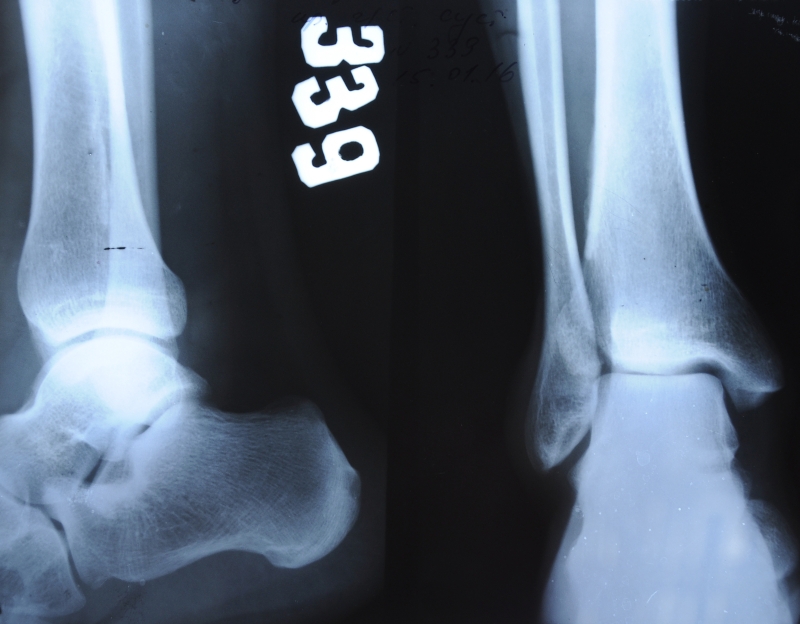 Неровность суставной щели при разрыве связок стопы Неровность суставной щели при разрыве связок стопы