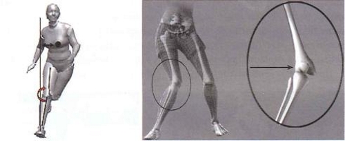 Нестабильность коленного сустава Нестабильность коленного сустава