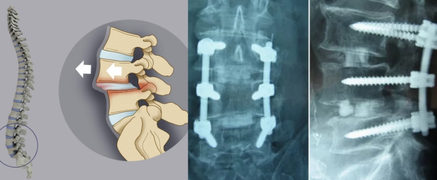 Стабилизация позвоночника Стабилизация позвоночника