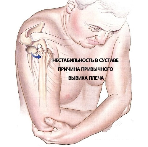 Неестественное положение плеча Неестественное положение плеча