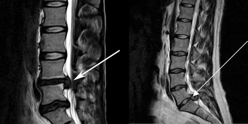 Невринома позвоночника на МРТ Невринома позвоночника на МРТ