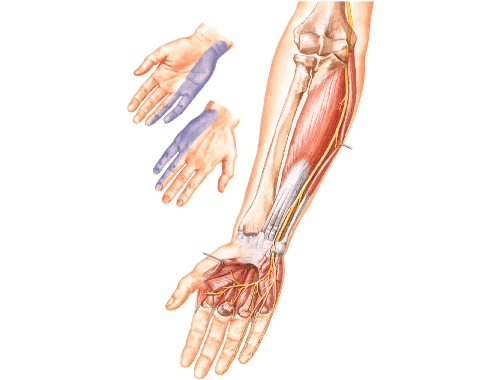 Неврит локтевого нерва Неврит локтевого нерва