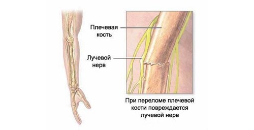Неврит лучевого нерва на фоне перелома Неврит лучевого нерва на фоне перелома