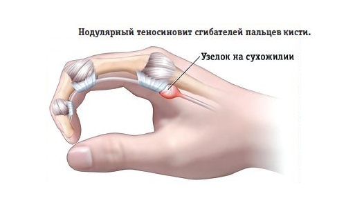 Нодулярный теносиновит Нодулярный теносиновит