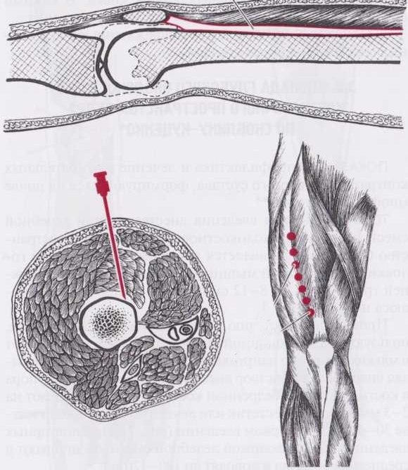 Обезболивание бедра Обезболивание бедра