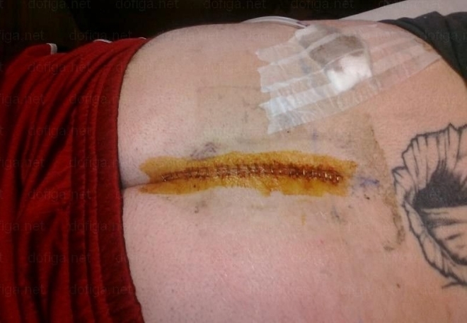 Обработка раны кисты копчика