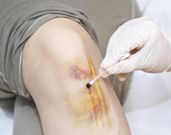 Йодная сетка при ушибах Йодная сетка при ушибах