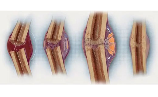 Образование костной мозоли Образование костной мозоли