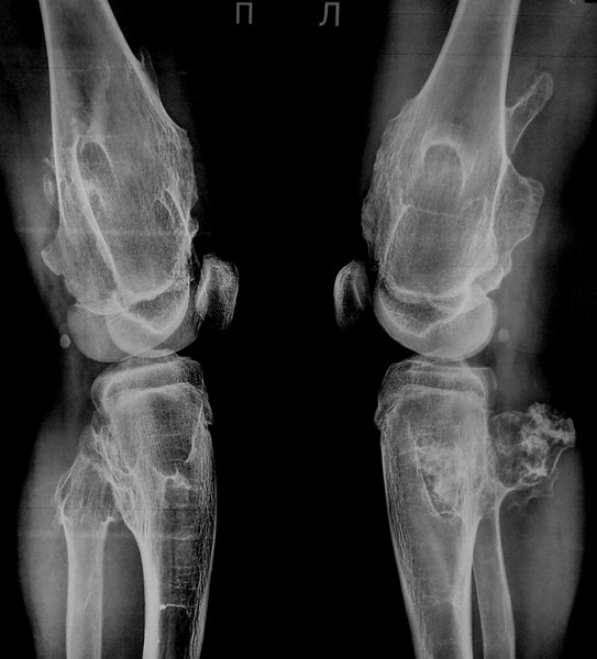 Образование патологически новой хрящевой ткани Образование патологически новой хрящевой ткани