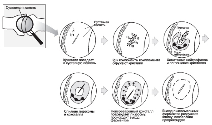 Образование ревматоидного фактора Образование ревматоидного фактора