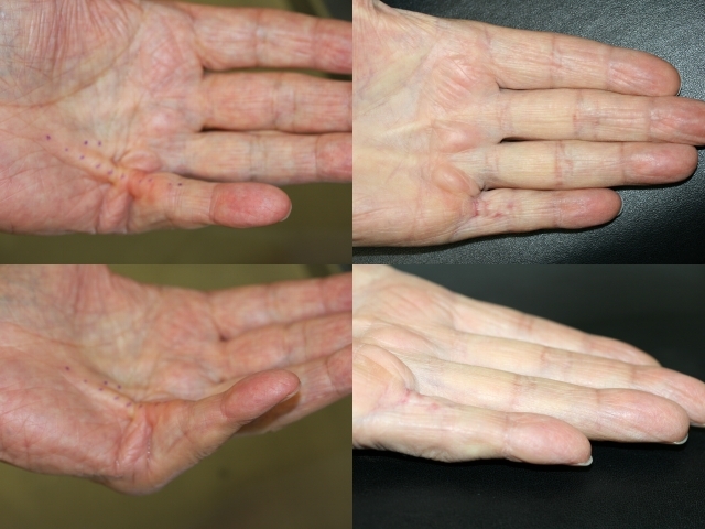 Образование уплотнений и бугорков Образование уплотнений и бугорков