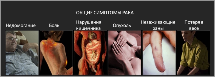 Общие симптомы рака Общие симптомы рака