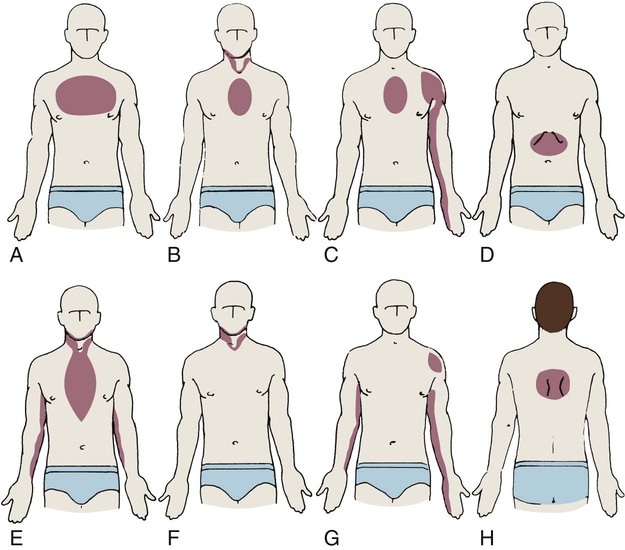 Очаги боли при стенокардии Очаги боли при стенокардии
