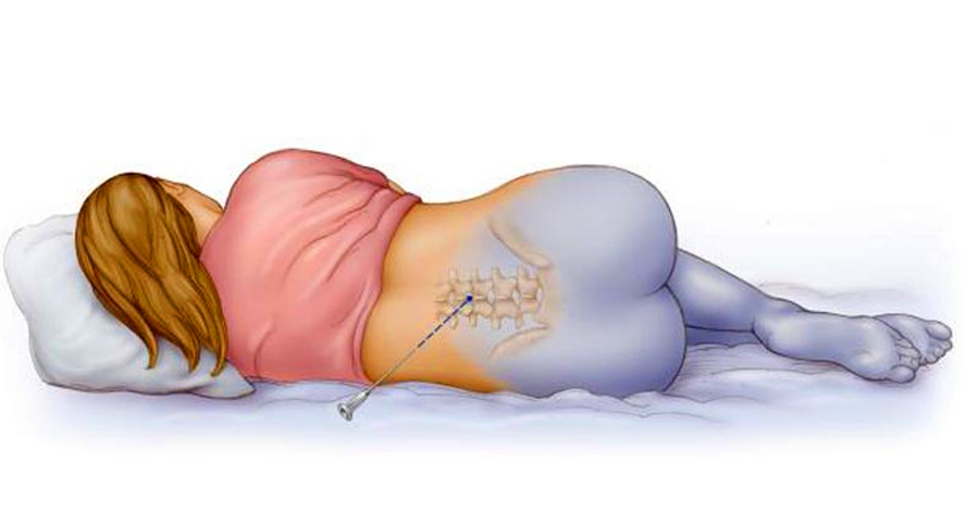 Онемение после анестезии Онемение после анестезии