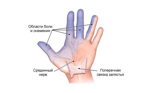 Онемение в руке Онемение в руке
