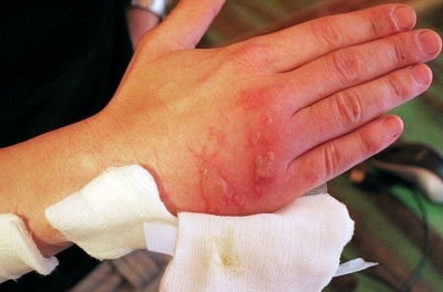 Опасность ожога от керосина Опасность ожога от керосина