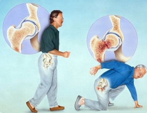 Опасность перелома при остеопорозе Опасность перелома при остеопорозе