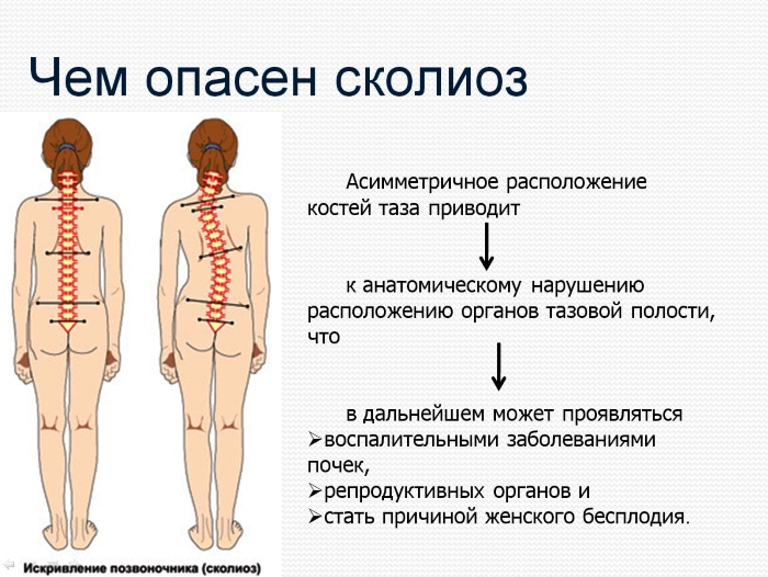 Опасность сколиоза Опасность сколиоза