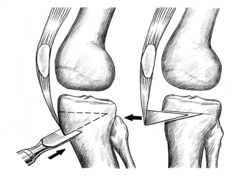 Оперативное лечение контрактуры при гонартрозе Оперативное лечение контрактуры при гонартрозе