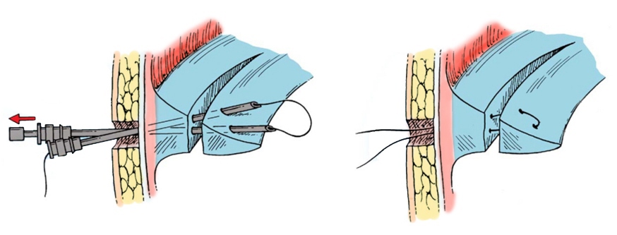 Сшивание мениска Сшивание мениска