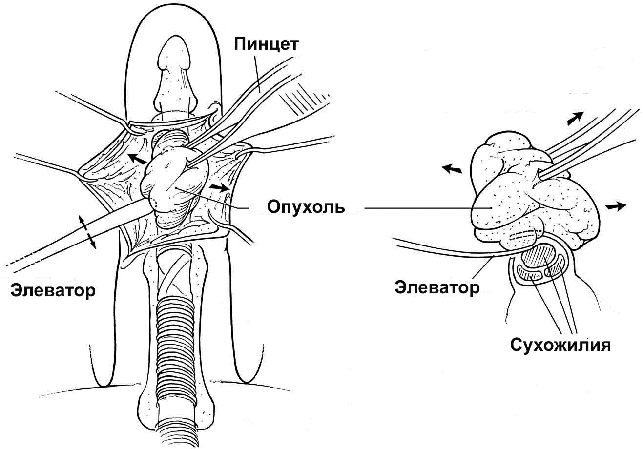 Оперативное лечение синовиомы Оперативное лечение синовиомы