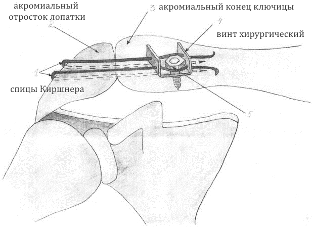 Оперативное лечение ключицы Оперативное лечение ключицы