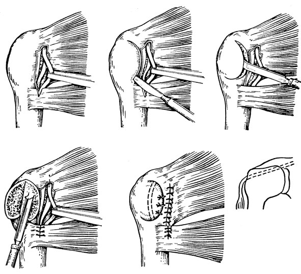 Оперативное лечение вывиха плеча по Краснову Оперативное лечение вывиха плеча по Краснову