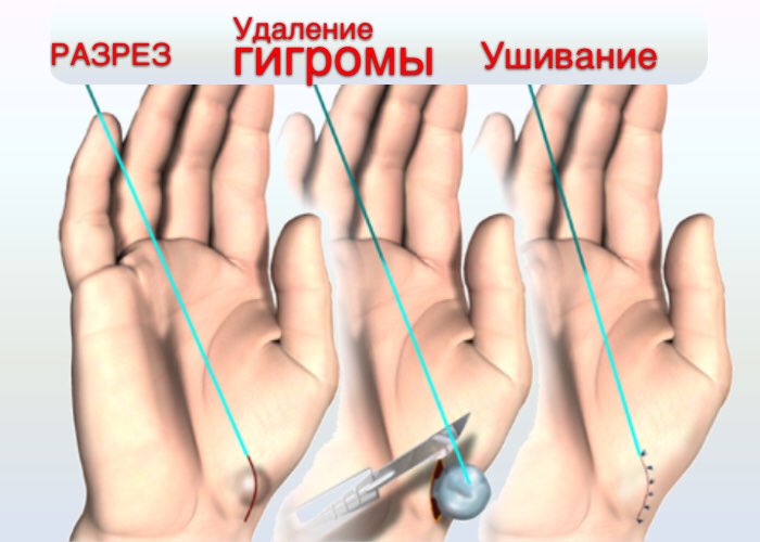 Оперативное удаление гигромы Оперативное удаление гигромы