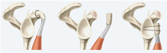 Схема операции Летарже Схема операции Летарже