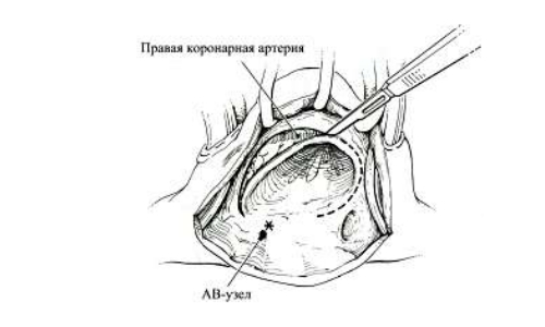Операция Вольффа сустава Операция Вольффа сустава