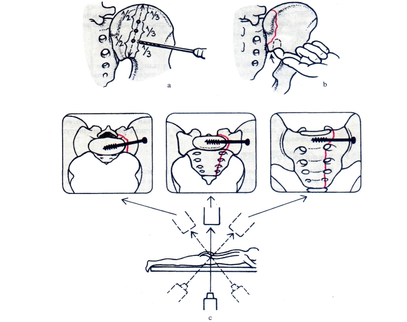Операция при переломе крестца Операция при переломе крестца