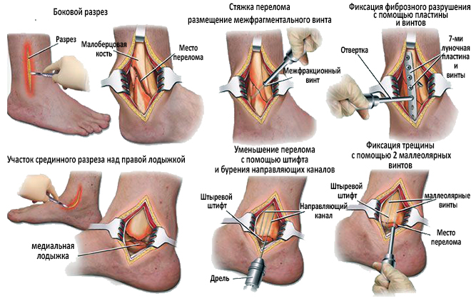 Операция при переломе лодыжки Операция при переломе лодыжки