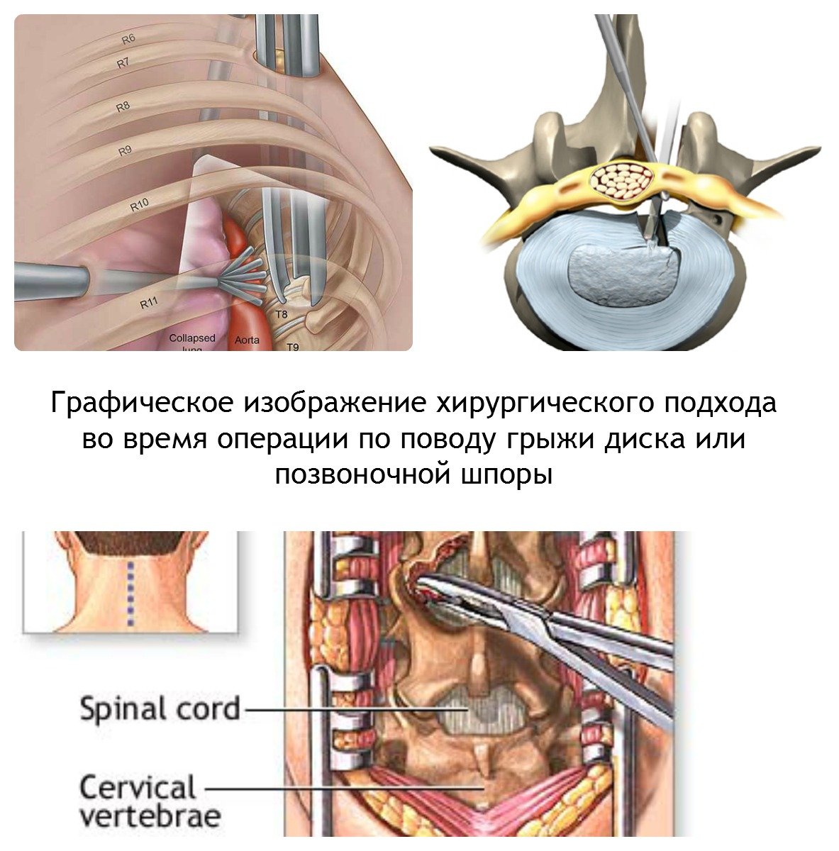 Операция при защемлении шейного нерва Операция при защемлении шейного нерва