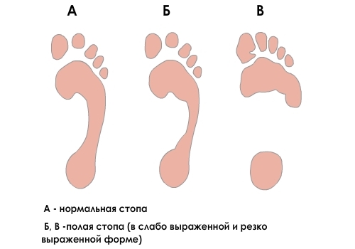 Определение полой стопы по следу Определение полой стопы по следу