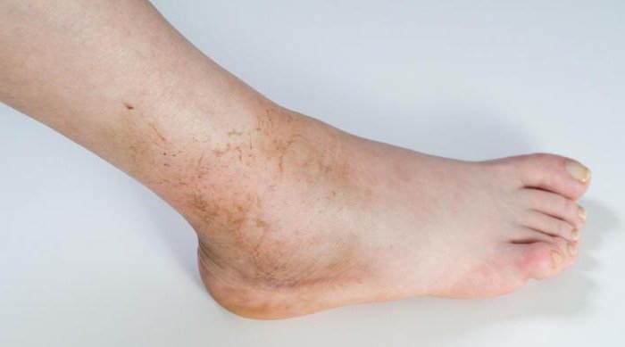 Опухание голеностопного сустава Опухание голеностопного сустава